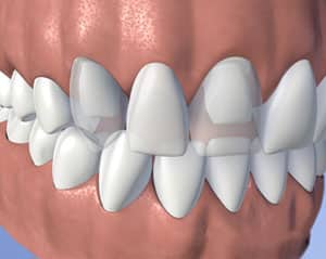 Digital dental model showing white tooth restorations on gum tissue mockup for cosmetic dentistry.