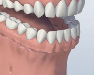 3D dental model showing upper and lower teeth alignment and jaw structure against neutral background.