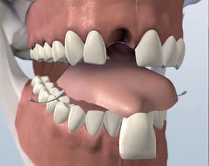 Dental model showing upper and lower teeth alignment with missing tooth gap and prosthetic crown placement.