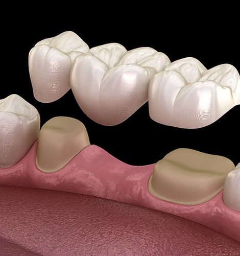 Dental implants illustration showing porcelain crowns positioned above gum tissue model.