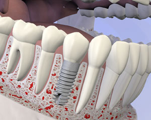 3D dental implant model showing tooth structure and implant placement in jawbone cross-section