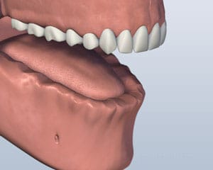 3D dental model showing upper teeth alignment and lower jaw structure for orthodontic assessment.