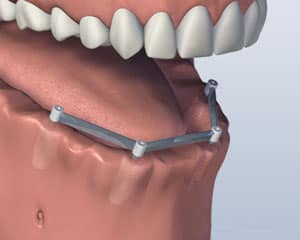 Dental implant bar structure showing titanium implant posts anchored in jawbone model.