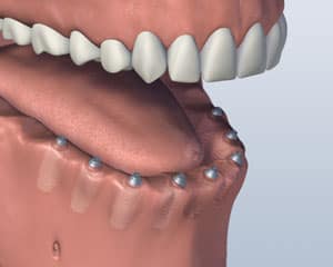Digital dental implant model showing upper teeth prosthesis on lower jaw with implant posts.