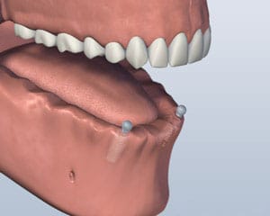3D dental implant model showing teeth alignment and jawbone structure for implant placement.