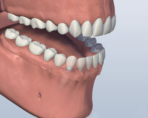 3D dental model showing upper and lower teeth alignment and bite relationship in dental restoration.