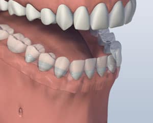 3D dental model showing upper and lower teeth alignment and jaw structure for orthodontic or prosthodontic education.