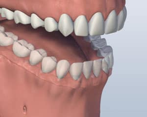 3D dental model showing upper and lower teeth alignment and bite relationship for orthodontic analysis.