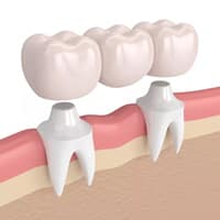 Dental bridge illustration showing three tooth crowns connecting two implant posts in gum tissue.