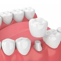 3D dental illustration showing tooth implant placement between natural teeth on pink gum model.