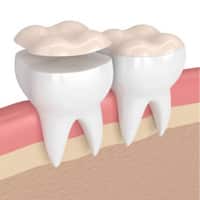 Dental crown placement illustration showing tooth structure with crown and natural tooth in gum tissue.