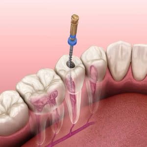 Dental drill performing root canal treatment on tooth model against pink background.