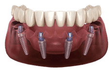 Dental implants model showing prosthetic teeth on implant posts in gum tissue.