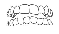Illustration of upper and lower dental arches showing tooth alignment and bite relationship.