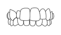Dental braces on upper and lower teeth showing orthodontic alignment treatment