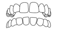 Dental diagram showing upper and lower teeth alignment and bite relationship for orthodontic assessment.