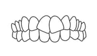 Illustration of aligned upper front teeth showing proper dental occlusion and healthy tooth positioning.