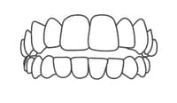 Illustration of aligned upper and lower teeth showing proper dental bite and orthodontic alignment.