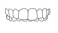 Clear dental aligners or braces shown in front view against white background.