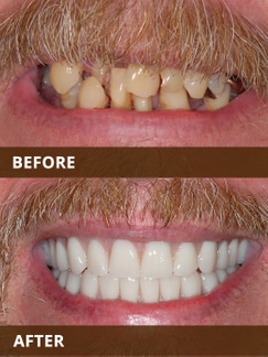 Before and after dental transformation showing discolored, damaged teeth versus bright, uniform white smile.