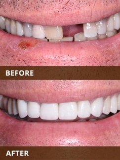 Before and after dental comparison showing tooth restoration and whitening results.
