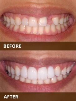 Before and after comparison of teeth whitening results showing improved brightness and whiteness.
