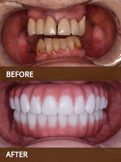 Before and after dental transformation showing discolored, misaligned teeth versus bright, perfectly aligned teeth.
