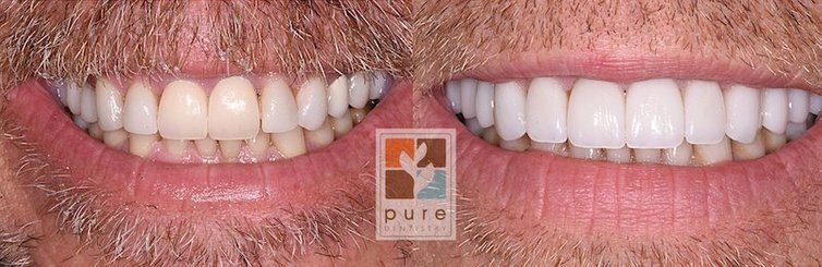 Before and after dental treatment showing improved tooth alignment and whiteness comparison.