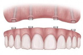 Dental implant bridge showing titanium fixtures in gum and ceramic crown restoration above.
