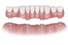 Dental implant bridge illustration showing prosthetic teeth supported by multiple implant fixtures in jawbone.