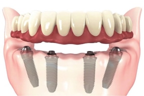 Dental implant diagram showing four titanium implants in lower jawbone with prosthetic teeth attached.