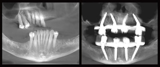 Dental X-rays showing panoramic and frontal views of teeth and jaw structure for orthodontic assessment.