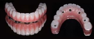 Dental implant models showing full arch prosthetic teeth from frontal and palatal views.